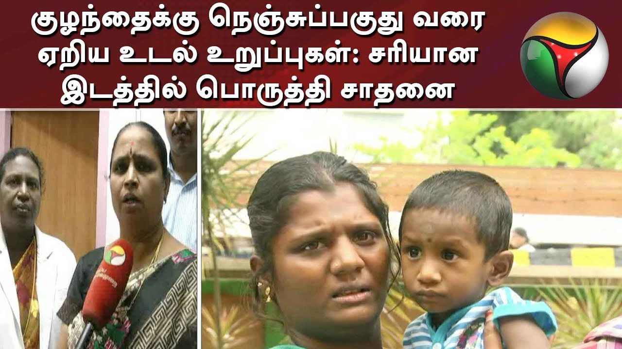 live tamil news 7 tv channels குழந்தைக்கு நெஞ்சுப்பகுது வரை ஏறிய உடல் உறுப்புகள்: சரியான இடத்தில் பொருத்தி சாதனை