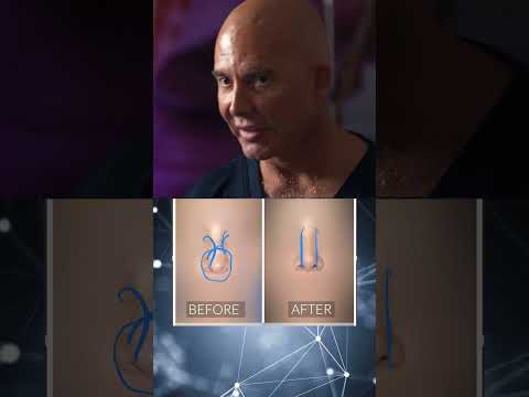 Video thumbnail: Nose transformation by Dr. Mendieta | Call Us: 305-680-5811 #miamiplasticsurgery · 4 Beauty Aesthetics Institute, Inc. - Constantino G. Mendieta, MD, FACS
