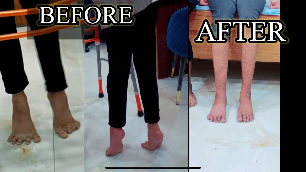 Recovery Foot drop deformity after 15 yrs