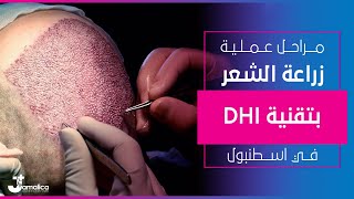مراحل عملية زراعة الشعر بتقنية DHI في تركيا
