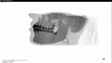 Ambivu dental MIP.avi