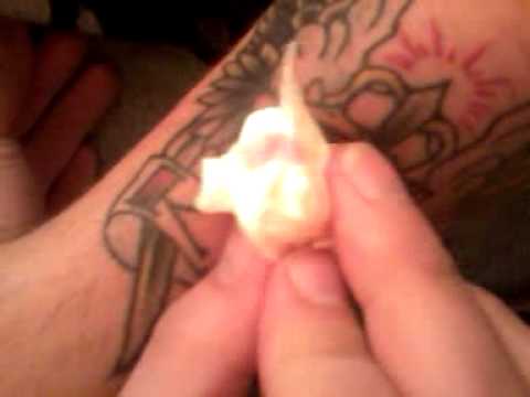 finger cyst pictures #11