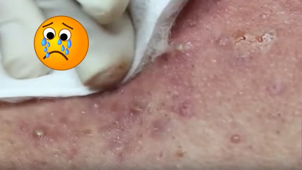 Removal Blackheads & Whiteheads On The Face Easy,Acne Treatment On Face,cystic blackheads #4