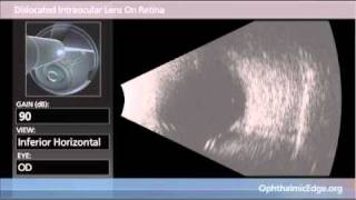 Dislocated Intraocular Lens On Retina