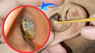 You Won’t Believe What Came Out of This Infected Ear! 😱 | Deep Ear Wax Removal ASMR | EP 177