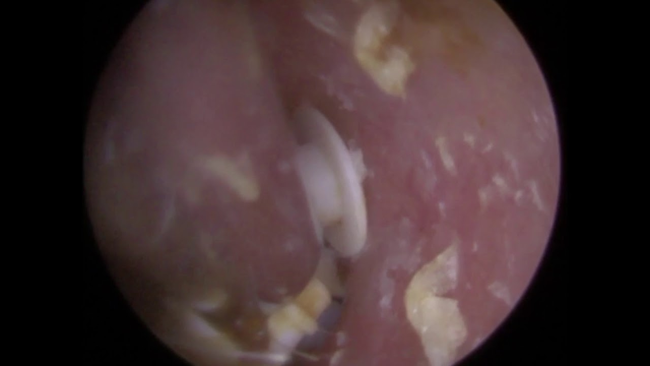 22 Hearing Aid Wax Filters Removed from Single Ear