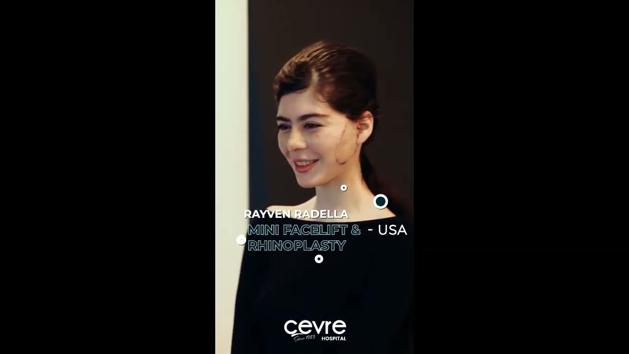 Mini Facelift at Cevre Clinic – Patient Review & Results