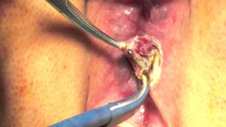 Emorroidectomia sec. Milligan-Morgan. Hemorrhoidectomy