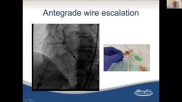 Coronary CTO PCI: Still the last frontier? CVI 2020 CME Webcast Series