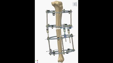 Ilizarov in action  - correction of angular tibial deformity