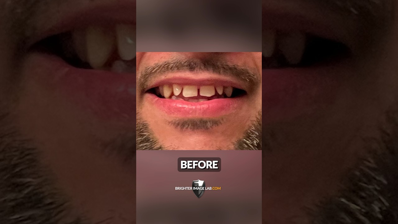 See How He FIXED His Gapped Teeth with Snap-On Veneers!