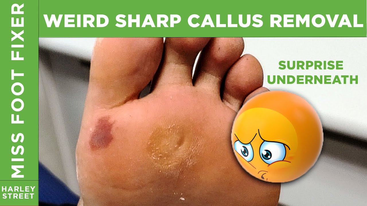 STRANGEST callus removal | how to remove callus professionally By Miss Foot Fixer Marion Yau