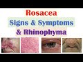 Rosacea Signs &amp; Symptoms (Including Ocular Rosacea &amp; Rhinophyma)