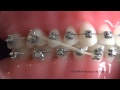 Les lastiques de classe 3 en technique orthodontique vestibulaire