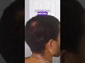 Amazing Hair Growth Journey: Will My Bald Spot Disappear! #comedy #hairgrowthjourney