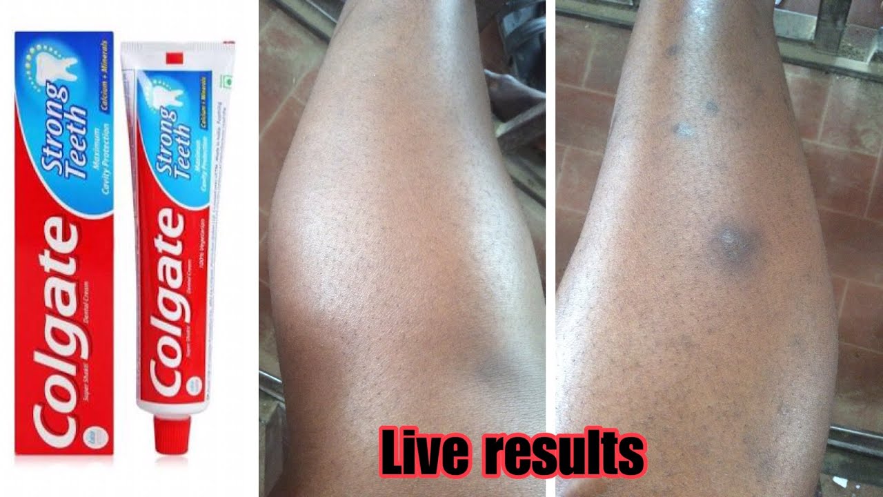 HOW TO:REMOVE DARK SPOTS FROM YOUR LEGS FAST,100% WORKING 