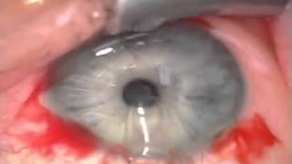 Операция на глазах по имплантации  линз (in english)