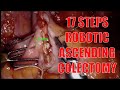 17 Steps of a Robotic Right / Ascending Colectomy with Intracorporeal Anastomosis