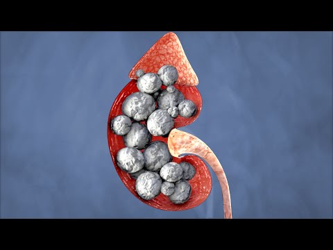 A Student Ate 108 Gummy Antacids For Breakfast. This Is What Happened To Her Kidneys.