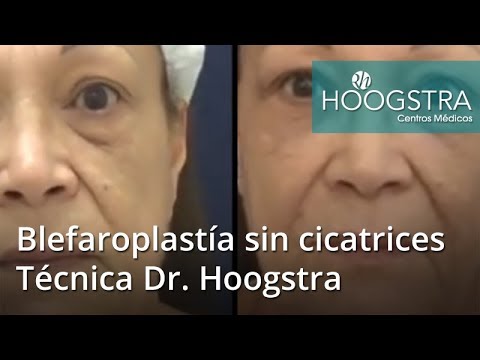 blepharoplasty laser Blefaroplastía sin cicatrices Técnica Dr. Hoogstra (18240)