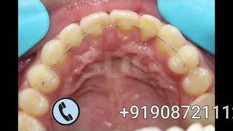 Invisalign Treatment in Chennai | teeth gap | No Braces | Dr.MKP | Senthil