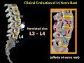 Neurological Evaluation Of The Lumbar Nerve Roots. Diagnoses of a herniated disc, nerve root injury.