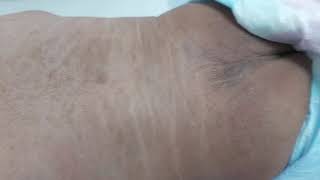 Neonatal hyperpigmentation