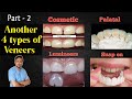 5 Types of Dental Veneers | Part - 2| Hindi