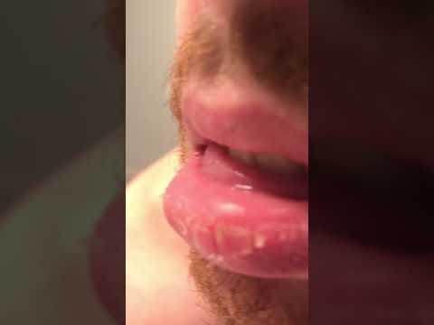 Dry Peeling Lips, Exfoliative Cheilitis - Week 2 - YouTube