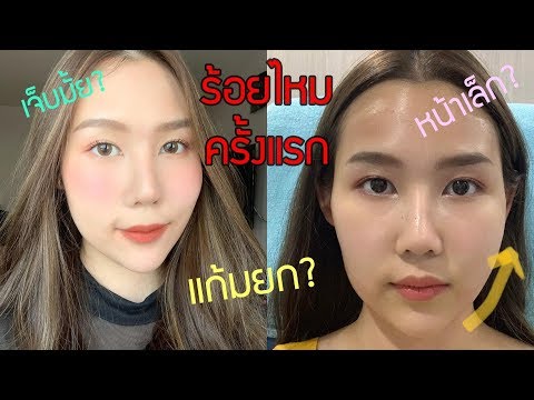 เล่าประสบการณ์ ร้อยไหมครั้งแรก! แก้มยก หน้าเล็ก เจ็บไหม? | Prawwave