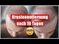 Haartransplantation Krustenentfernung | Anleitung Entfernung nach 10 tagen ( tutorial )
