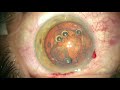 Using Callisto to center a Zepto capsulotomy with implantation of a Symfony IOL