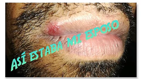 Qual o período de contágio da herpes labial?