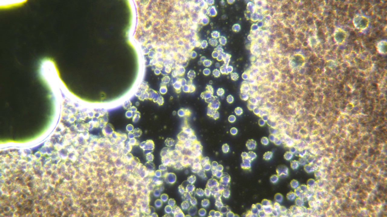 my live blood infection showing Lyme spirochete and coinfections YouTube