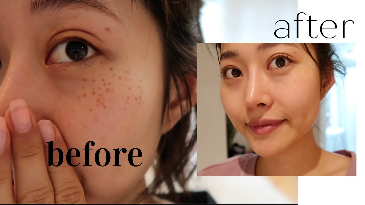 Getting my freckles removed in Korea full process, price, healing, and tips YouTube