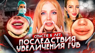 видео: НЕ КОЛИТЕ ГУБЫ!!! ПОСЛЕДСТВИЯ УВЕЛИЧЕНИЯ ГУБ СПУСТЯ 6 ЛЕТ картинка: НЕ КОЛИТЕ ГУБЫ!!! ПОСЛЕДСТВИЯ УВЕЛИЧЕНИЯ ГУБ СПУСТЯ 6 ЛЕТ