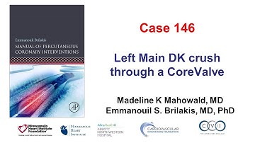 Case 146: PCI Manual - DK crush through a CoreValve