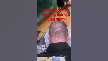 The truth about new hair solution technique. #smp #scalpmicropigmentation #hairtransformation#