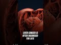 Early Detection of Liver Cancer: How MoleculeDx Reads Blood Signals Before Symptoms Appear