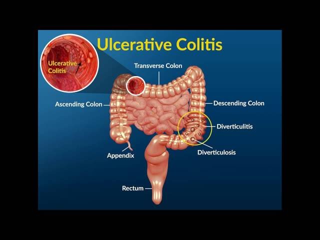 Tratamiento para la diverticulitis del colon