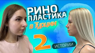 видео: Ринопластика в Турции до и после. Результат огонь картинка: Ринопластика в Турции до и после. Результат огонь