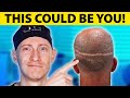Botched hair transplant results  hair surgeon reacts