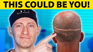 BOTCHED Hair Transplant Results | Hair Surgeon Reacts