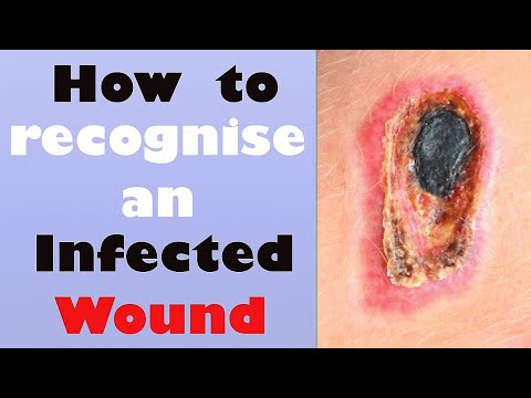 Video: Infected Cut: Symptom, Behandling, Förebyggande, Komplikationer