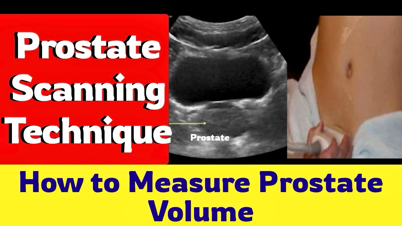 Measuring Shape Prostate Prostate Ultrasound Scanning Technique || How to Measure Prostate ...