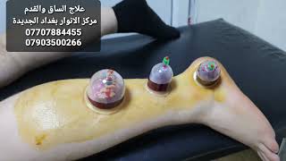 علاج الساق والقدم مركز الانوار بغداد الجديدة 0707884455/07903500266