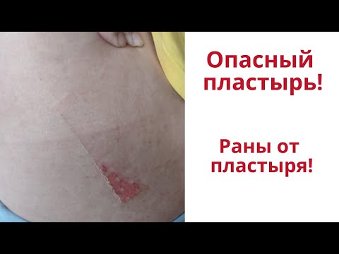 Перцовый пластырь. Раны и ожоги на коже от пластыря. Личный опыт. Советы врача.