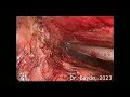 Laparoscopic splenectomy for splenomegaly