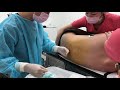 リピーターの患者様！二の腕の脂肪吸引の結果に大満足しておなかの脂肪吸引を受ける！術中