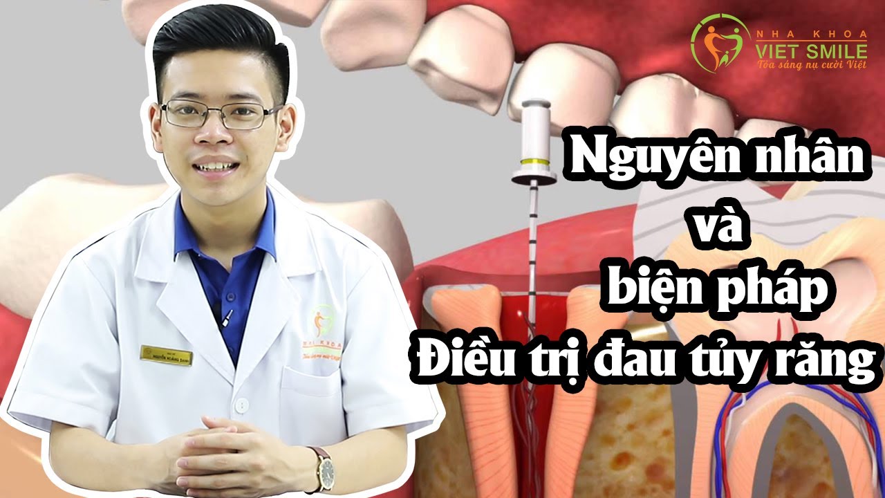 Outline Video Răng viêm tủy - Nguyên nhân và cách điều trị